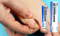 Nistatin krem antibiyotik midir, ne işe yarar ve kimler kullanabilir?