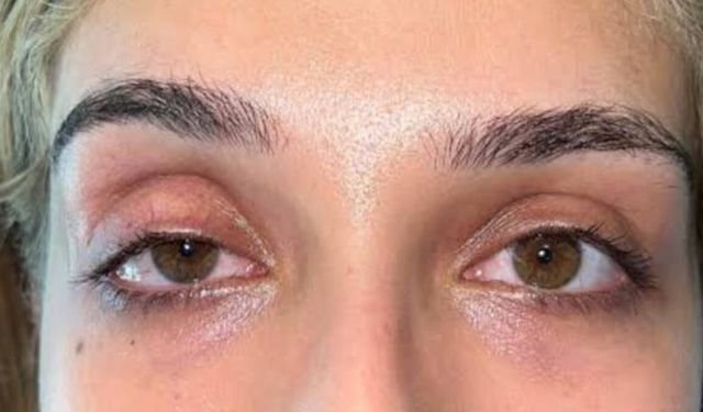 Ekran Başında Çalışanlara Uyarı: Göz Kapaklarını da Etkiliyor