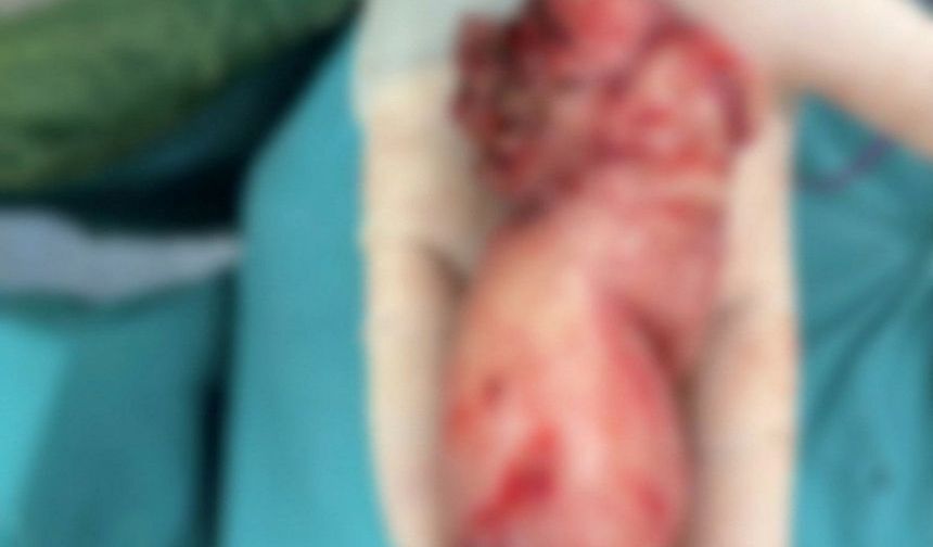 Alanya'da tarihi ameliyat! 13 Santimlik dev tümör çıkarıldı